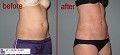 Laser Lipo and Vein Center